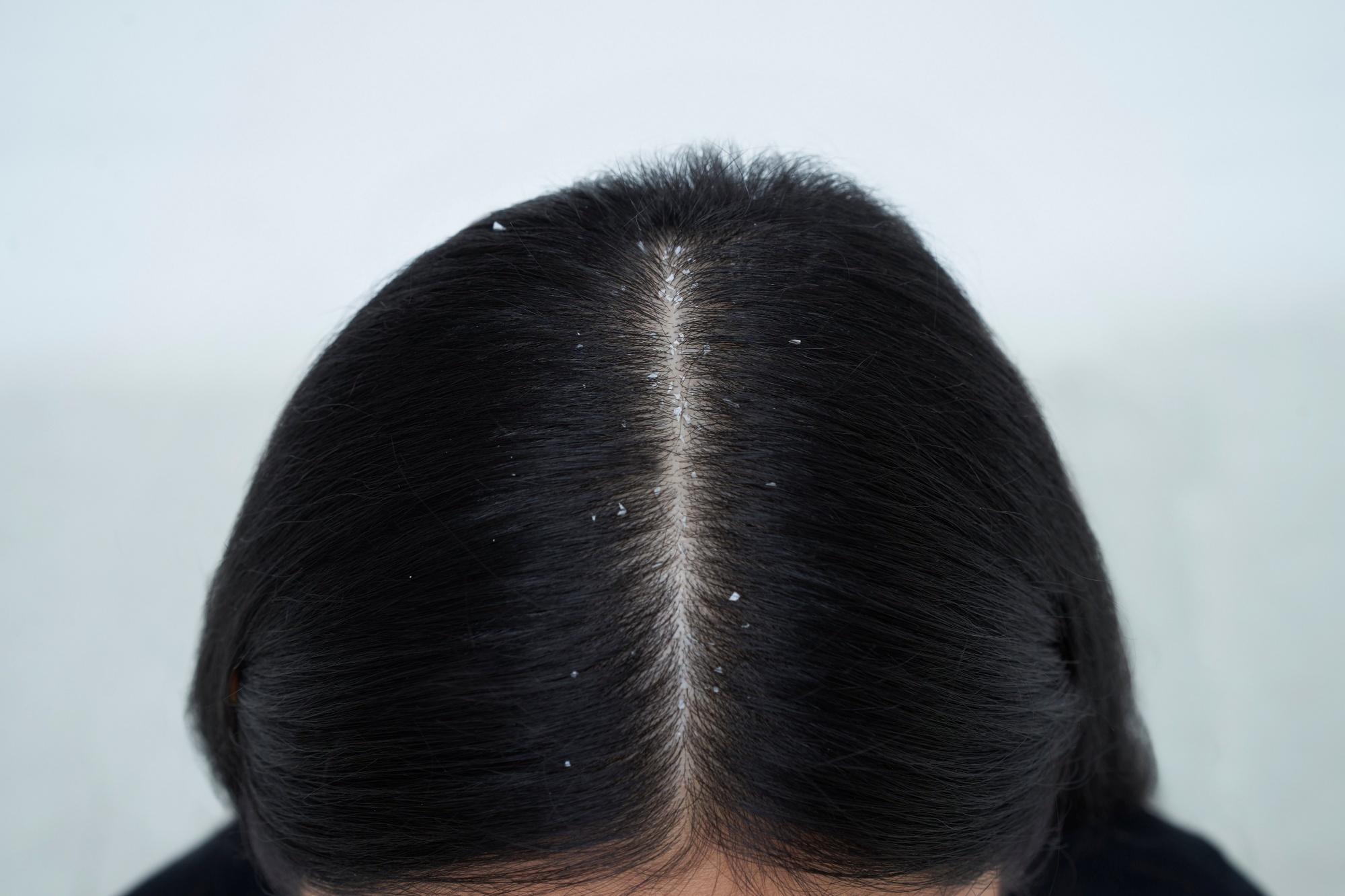 Things to know about dandruff | Natures Gentle Touch
