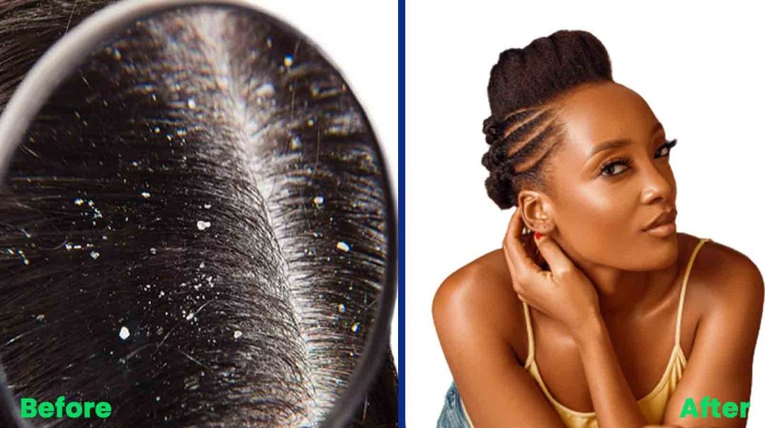 Problems, Causes, and Solutions to Dandruff & Itchy scalp | Natures Gentle  Touch